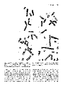 Рис. 5.29. Хромосомы больного с анемией Фанкони. А Хроматиновый разрыв. Б. Две фигуры хроматиновых обменов с участием негомологичных хромосом. В. Гексагональная фи-