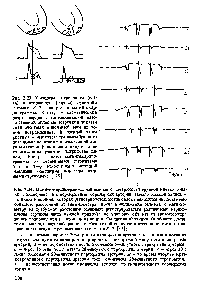 Рис. 2.23. <a href="/info/1076792">Механизмы первичного</a> (слева) и вторичного (справа) смещения сегмента S-T электро- и магнитокардиограммы. Вверху - схематический разрез сердца с заштрихованной патологической областыо (стрелкой показан <a href="/info/1890185">эквивалентный дипольный</a> момент токов повреждения). В <a href="/info/916048">средней части</a> рисунка - Импульсы трансмембранного потенциала действия в неизмененной части миокарда (сплошная линия) и на патологическом участке (штриховая ли- ния). Внизу - цикл магнитокардиограммы со смещенными сегментами S-T я T-Q <a href="/info/776110">относительно истинной</a> изолинии (смещения показаны жирными стрелками) [175]